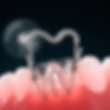 Diagram showing the mechanism of action of silver diamine fluoride