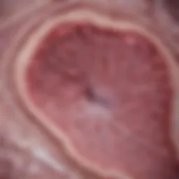 Histological slide of Erdheim-Chester disease showcasing histiocytic infiltration