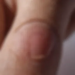 Close-up view of a fingertip showing skin changes related to cancer